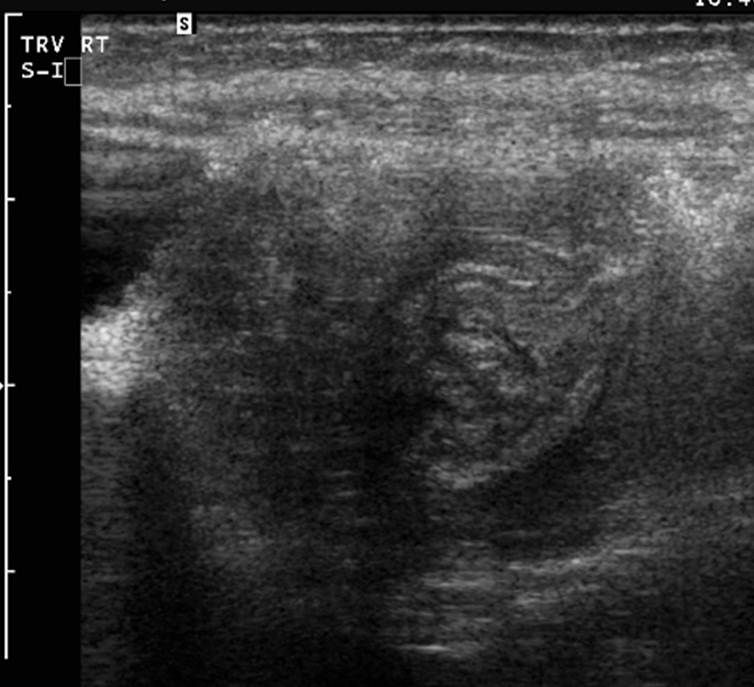 Intussusception